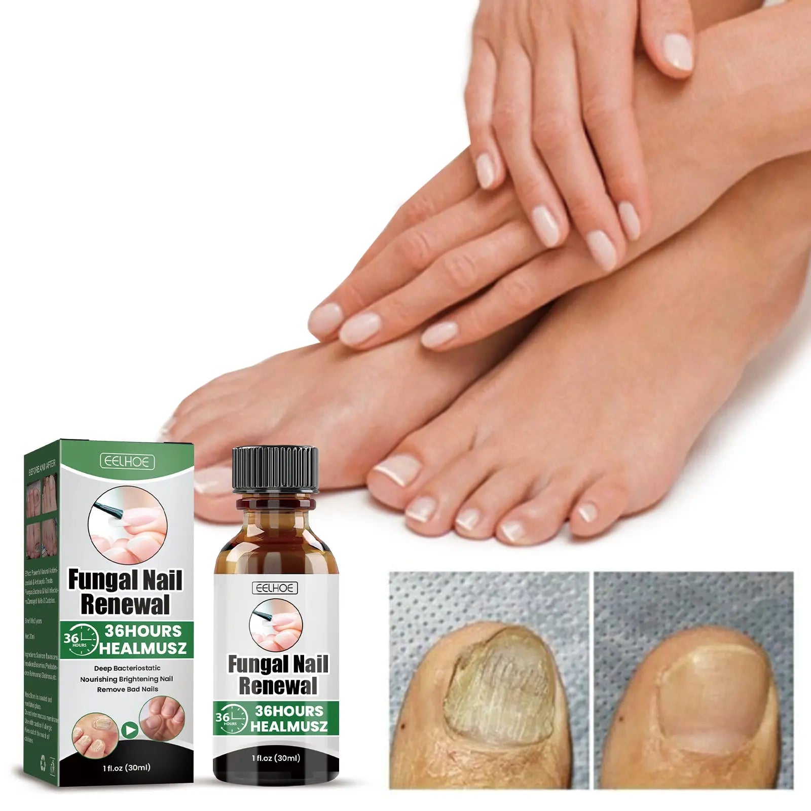 EELHOE Gray Nail Repair Remove Gray Nail Nourishing Lotion, Brightening Soft Nails Moisturizing Nail Care Solution For Hands, Feet And Nails eprolo